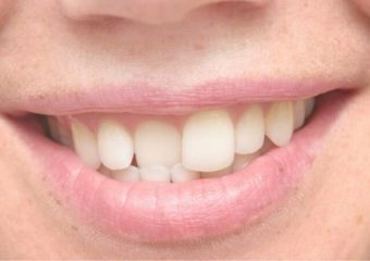 آشنایی با انواع ناهنجاری اپن بایت | بهترین دندانپزشک زیبایی اصفهان