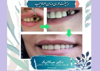 ایمپلنت فوری دندان سه بالا چپ | بهترین دندانپزشک اصفهان