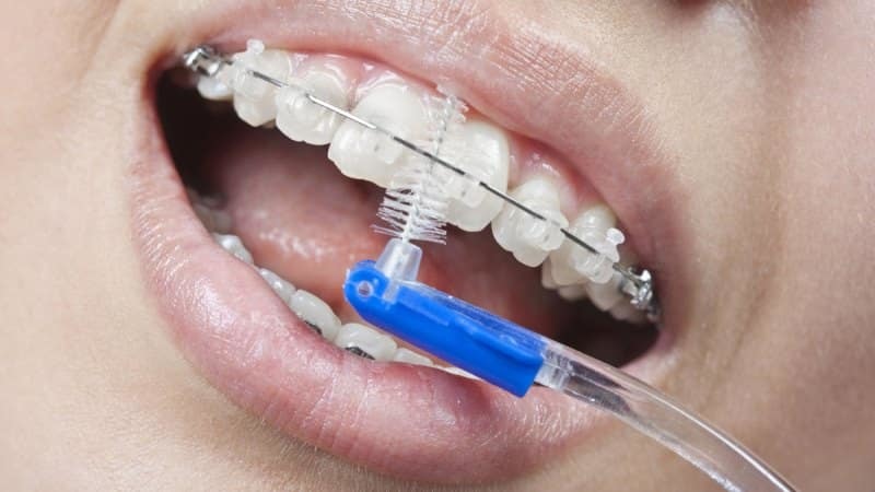 بررسی انواع مختلف مال اکلوژن | بهترین دندانپزشک زیبایی اصفهان