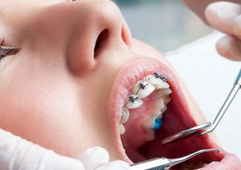 بررسی انواع مختلف مال اکلوژن | بهترین دندانپزشک زیبایی اصفهان