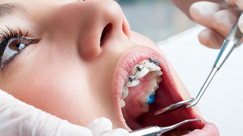 بررسی انواع مختلف مال اکلوژن | بهترین دندانپزشک زیبایی اصفهان