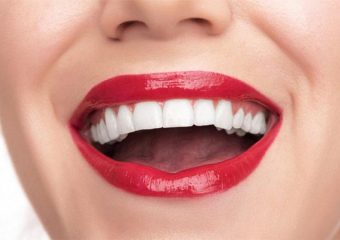 بررسی تفاوت های ونیر و لومینیرز دندان | بهترین ایمپلنت اصفهان