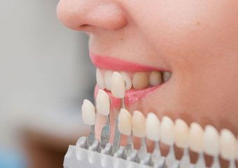 شباهت های ونیر و لومینیرز | بهترین ایمپلنت اصفهان