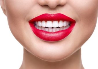 بلیچینگ دندان چه عوارضی دارد؟ | بهترین ایمپلنت اصفهان