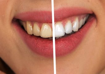 راه های پیشگیری و درمان تغییر رنگ دندان‌ها | بهترین ایمپلنت اصفهان