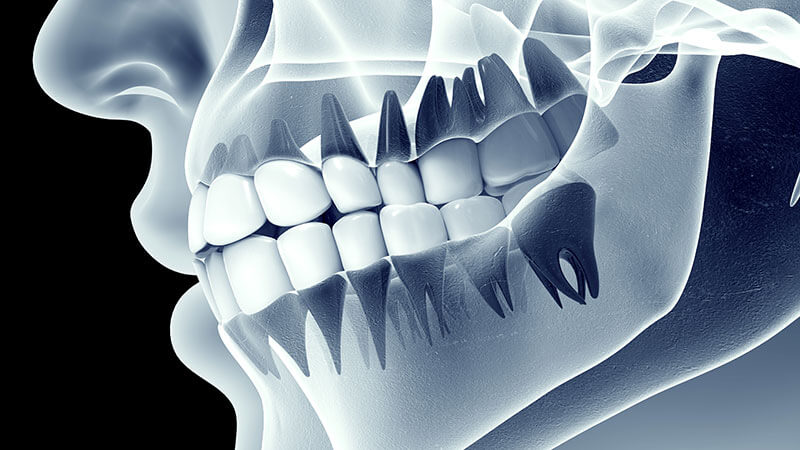 علائم و عوامل مختلف بروز مال اکلوژن دندان | بهترین ایمپلنت اصفهان