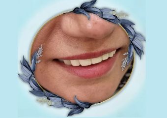 نمونه ایمپلنت دندان‌های جلویی | بهترین دندانپزشک اصفهان | بهترین ایمپلنت اصفهان