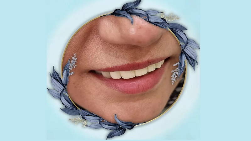 نمونه ایمپلنت دندان‌های جلویی | بهترین دندانپزشک اصفهان | بهترین ایمپلنت اصفهان