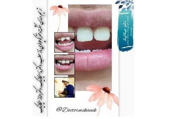 نمونه ترمیم دندان شکسته | بهترین دندانپزشک اصفهان