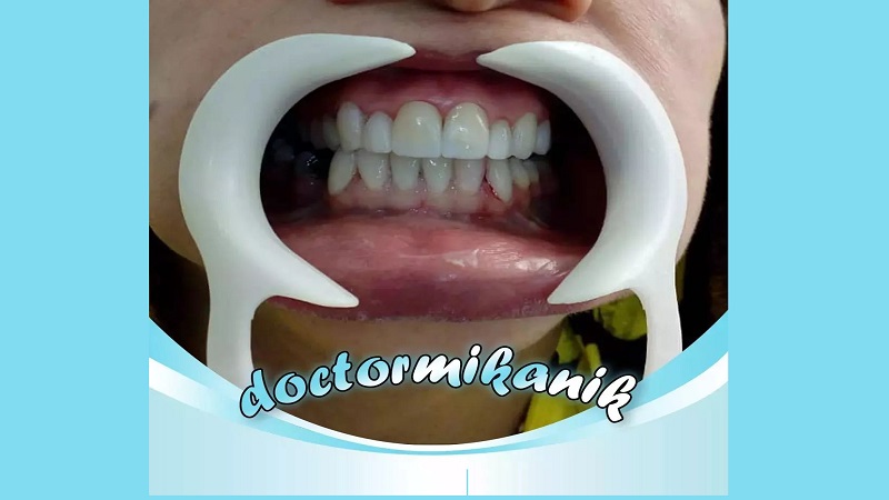 نمونه عمل ترمیم زیبایی دندان | بهترین دندانپزشک اصفهان | بهترین ایمپلنت اصفهان