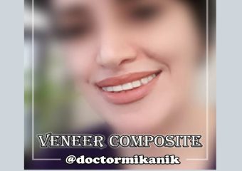 نمونه ونیر کامپوزیت | بهترین دندانپزشک اصفهان | بهترین ایمپلنت اصفهان