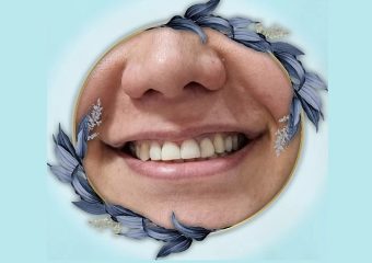 نمونه ونیر کامپوزیت با رنگ طبیعی | بهترین دندانپزشک اصفهان