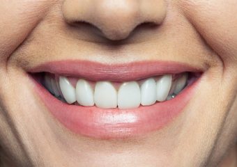 آشنایی علائم و عوارض آندربایت | بهترین دندانپزشک اصفهان