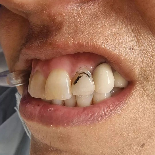 اصلاح تغییر رنگ و بدفرمی دندان با استفاده از لمینت کامپوزیتی | بهترین دندانپزشک زیبایی اصفهان