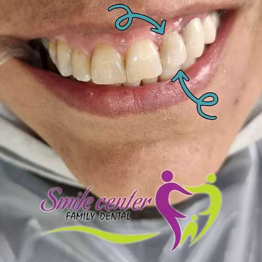 اصلاح تغییر رنگ و بدفرمی دندان با استفاده از لمینت کامپوزیتی | بهترین دندانپزشک زیبایی اصفهان