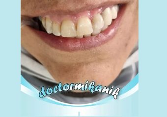 اصلاح تغییر رنگ و بدفرمی دندان با استفاده از لمینت کامپوزیتی | بهترین دندانپزشک زیبایی اصفهان