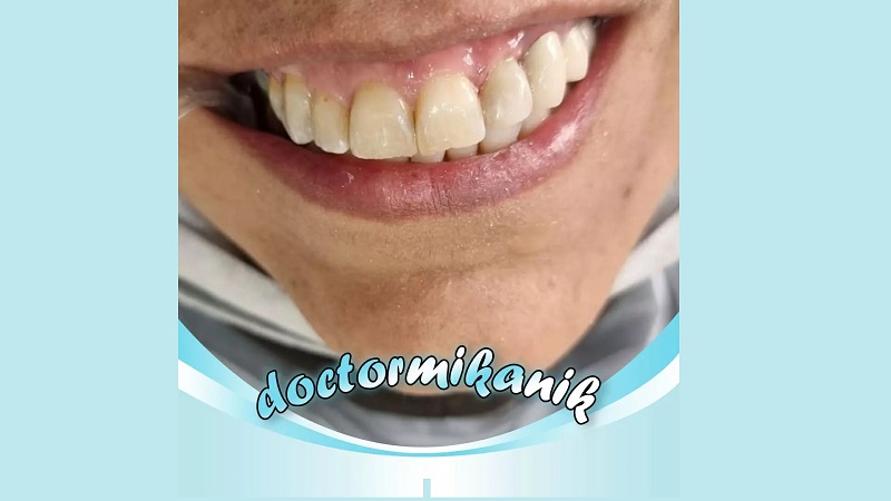 اصلاح تغییر رنگ و بدفرمی دندان با استفاده از لمینت کامپوزیتی | بهترین دندانپزشک زیبایی اصفهان