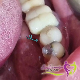 بازسازی کامل دندان شماره پنج فک پایین | بهترین دندانپزشک زیبایی اصفهان