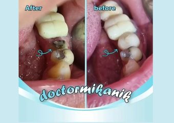 بازسازی کامل دندان شماره پنج فک پایین | بهترین دندانپزشک زیبایی اصفهان