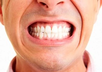 بررسی عوارض ناشی از اپن بایت | بهترین دندانپزشک اصفهان