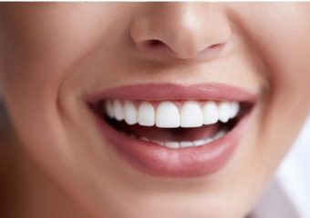 راهنمای انتخاب کامپوزیت یا لمینت دندان | بهترین دندانپزشک اصفهان