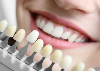 راهکارهای افزایش طول عمر لمینت دندان | بهترین ایمپلنت اصفهان