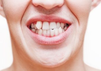 راهکارهای پیشگیری و درمان مال الکوژن دندان ها | بهترین دندانپزشک اصفهان