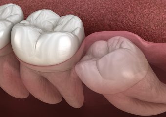رشد ، آسیب و ترمیم دندان عقل | بهترین ایمپلنت اصفهان