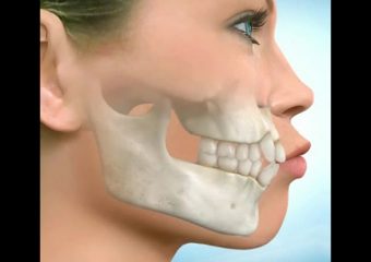 پاسخ به پرسش هایی پیرامون آندربایت | بهترین دندانپزشک اصفهان