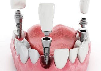 پیوند استخوان در ایمپلنت دندان | بهترین ایمپلنت اصفهان