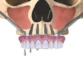 کاربردهای ایمپلنت دندان زیگوماتیک | بهترین ایمپلنت اصفهان