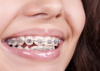 آنچه باید در مورد ارتودنسی کوتاه مدت بدانید | بهترین ایمپلنت اصفهان