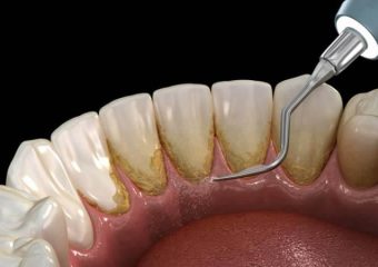 بررسی موارد مورد نیاز به جرم گیری دندان | بهترین ایمپلنت اصفهان