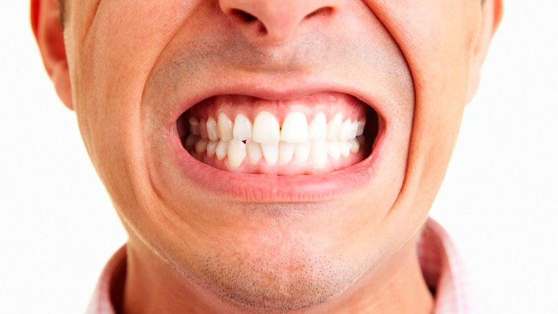عوامل بروز دندان قروچه چیست؟ | بهترین ایمپلنت اصفهان