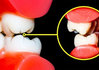 عوامل بروز دندان قروچه چیست؟ | بهترین ایمپلنت اصفهان