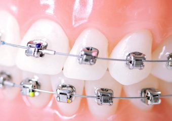 مراحل انجام و مراقبت از ارتودنسی دیمون | بهترین دندانپزشک اصفهان