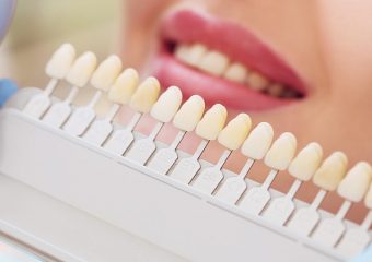 مزایا و عیوب انجام لمینت برلیانس | بهترین دندانپزشک اصفهان