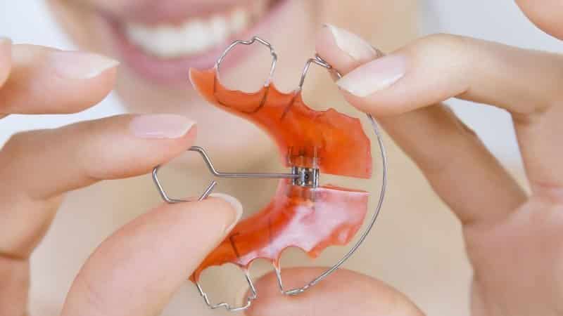 مزایا و معایب انواع مختلف ارتودنسی متحرک دندان | بهترین دندانپزشک اصفهان