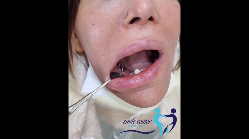 نمونه بازسازی دندان‌های از دست رفته با ایمپلنت | بهترین ایمپلنت اصفهان