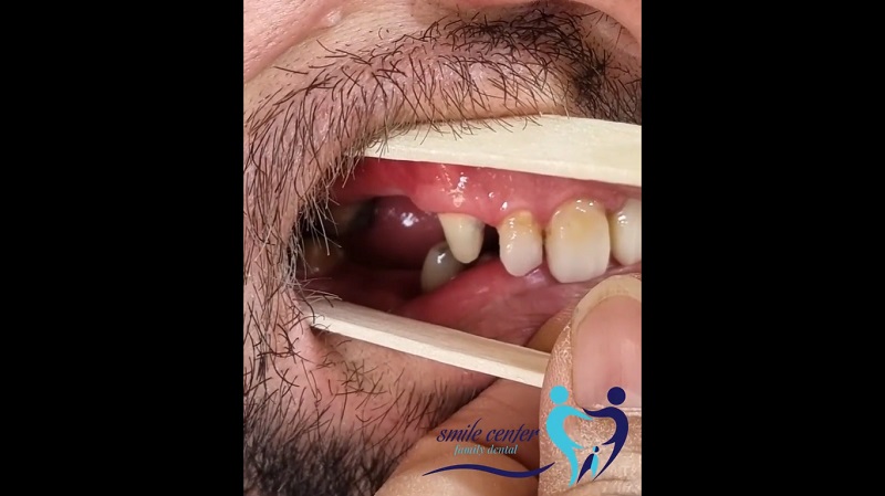 نمونه بازسازی دندان‌های از دست رفته‌ی فک بالا و پایین | بهترین ایمپلنت اصفهان