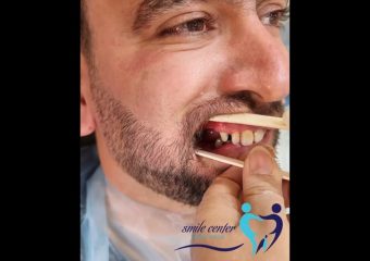 نمونه بازسازی دندان‌های از دست رفته‌ی فک بالا و پایین | بهترین ایمپلنت اصفهان