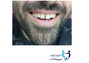 نمونه لمینیت سرامیکی دندان بالا و دندان پایین | بهترین ایمپلنت اصفهان