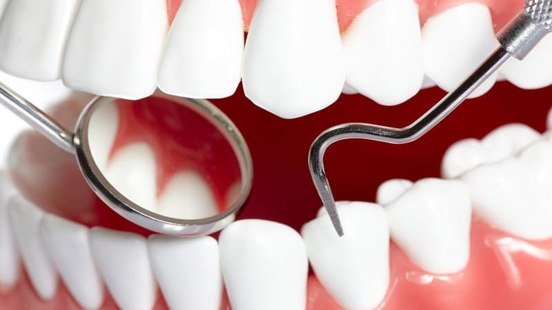همه چیز در مورد لمینت متحرک دندان | بهترین دندانپزشک اصفهان