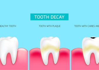 پوسیدگی زود هنگام به دلیل لمینت دندان‌ها | بهترین دندانپزشک اصفهان