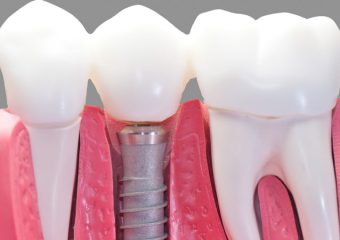 چه زمانی به ایمپلنت دندان نیاز داریم؟ | بهترین دندانپزشک اصفهان