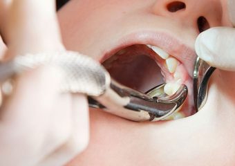 نکات مراقبتی قبل و بعد از کشیدن دندان | بهترین دندانپزشک اصفهان