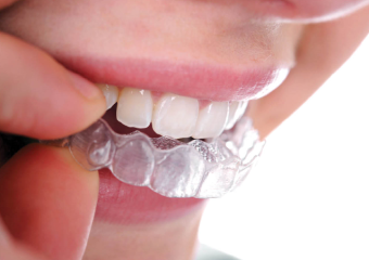 ارتودنسی نامرئی با پلاک های شفاف | بهترین دندانپزشک زیبایی اصفهان