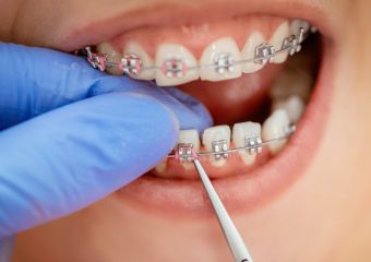 ارتودنسی پیشگیری | بهترین دندانپزشک زیبایی اصفهان