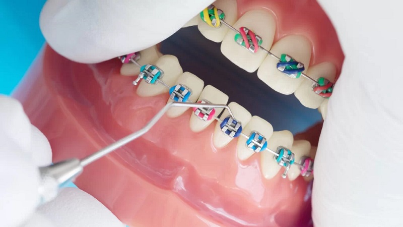 بررسی کاربردهای ارتودنسی رنگی | بهترین ایمپلنت اصفهان