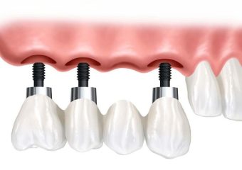 تعیین بهترین زمان برای انجام ایمپلنت دندان | بهترین ایمپلنت اصفهان